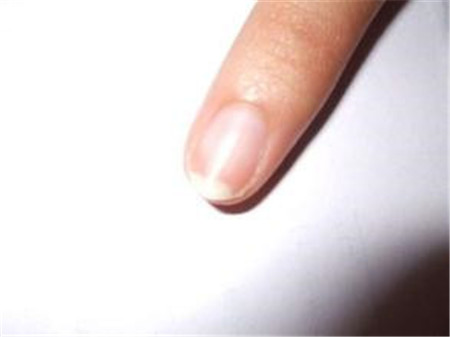 林赛氏指甲是什么病