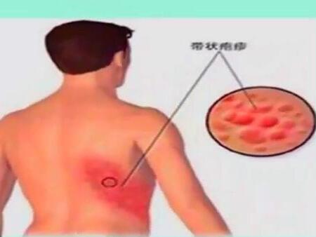 带状疱疹长一圈会死吗 带状疱疹长一圈会死吗