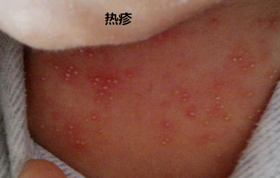 婴儿湿疹和热疹的区别 牢记六大区别不再混淆