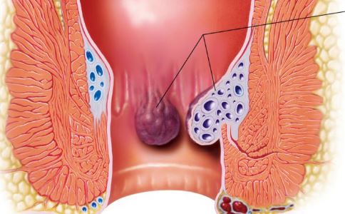 化痔栓等3种药品转换为处方药 不良反应及禁忌了解下