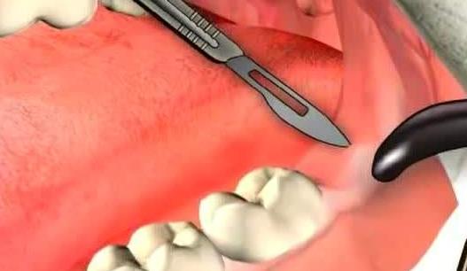 拔智齿后悔死了：智齿拔掉后真的让我们后悔吗？