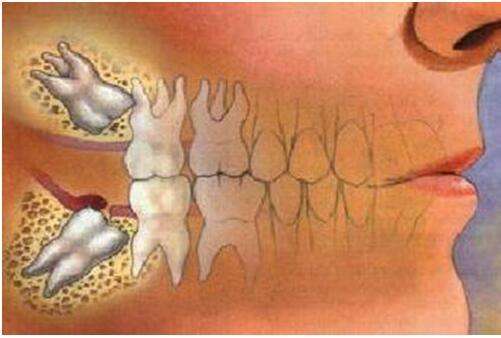 拔智齿后悔死了：智齿拔掉后真的让我们后悔吗？