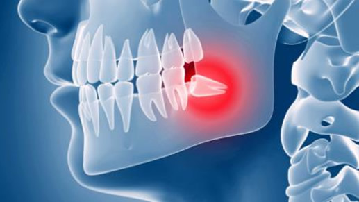 拔智齿后悔死了网友经历分享：什么情况下智齿不用拔
