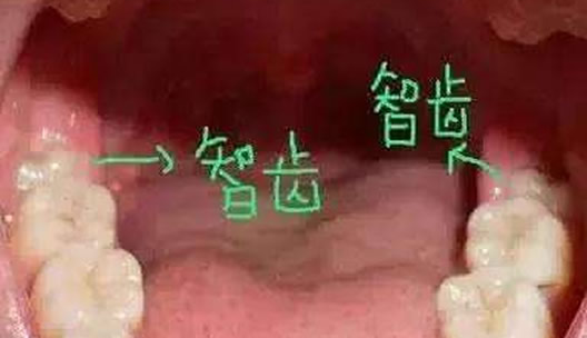 拔智齿后悔死了网友经历分享：什么情况下智齿不用拔