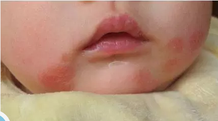 婴儿湿疹不用怕 60%的情况下用它能治好！