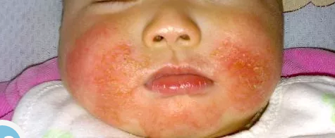 婴儿湿疹不用怕 60%的情况下用它能治好！