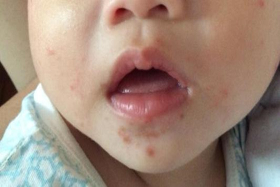 越早对小孩口足手病轻微图片有所认识 治疗起来就越不费劲