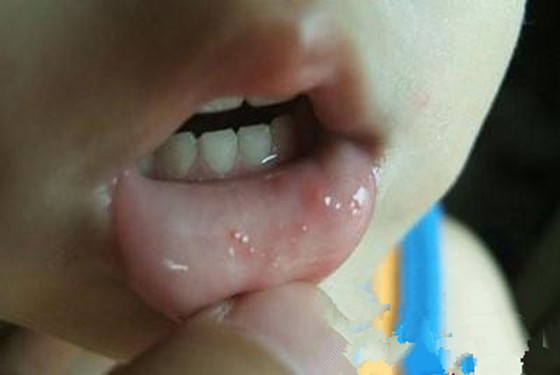 越早对小孩口足手病轻微图片有所认识 治疗起来就越不费劲