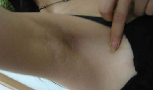 什么人会有狐臭:这3种人注意了有狐臭该怎么办