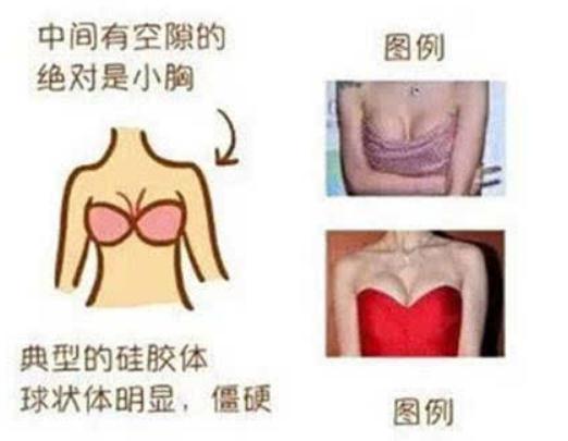 隆过的胸和天然的胸在手感上有区别吗（网友感受）