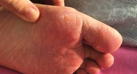 夏天脚气重？13个民间偏方教你脚气怎么根治！简单实用！