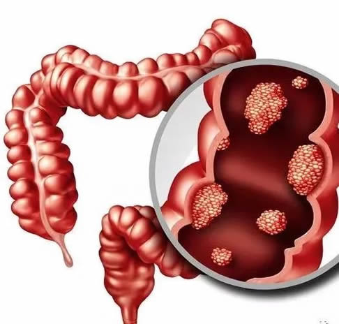 大便出鲜血是怎么回事：大便出血原因详情及怎么办