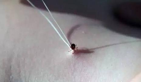 蜱虫图片：家里有蜱虫不小心被咬了怎么办