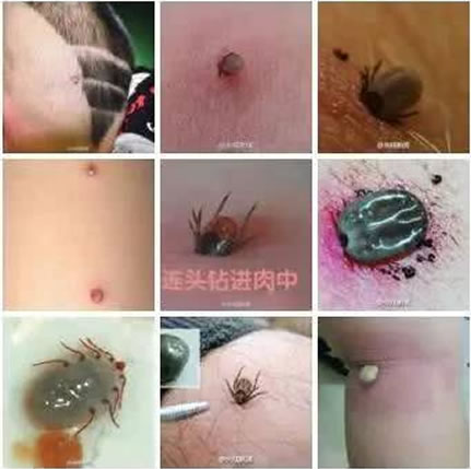 人被蜱虫叮咬后症状图片：被叮咬后别急医生教你辨别