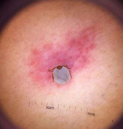 人被蜱虫叮咬后症状图片：被叮咬后别急医生教你辨别