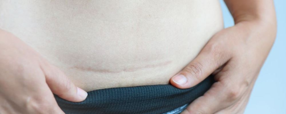 剖腹产后怎样减肥 推荐这四种方法