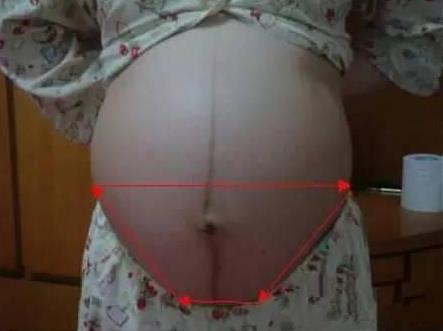妊娠线看男女准吗