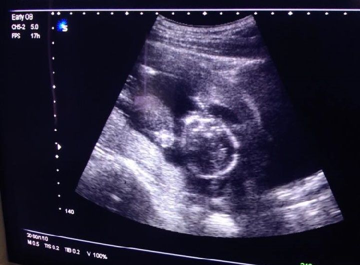 检查时明明是“女孩”，生下来却是男宝，“女翻男”真的存在吗？