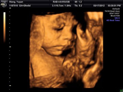 四维女宝宝三条线特征图片长什么样,四维男宝也有三条线吗?