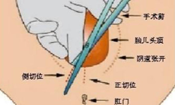 顺产侧切手术全过程以及术后护理的正确方法（附图）