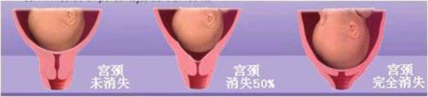 顺产内检真实图片 孕妇内检示意图