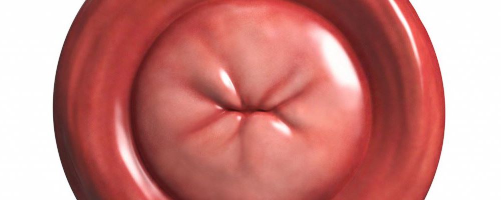 国产HPV疫苗获批 如何预防HPV