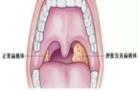 扁桃体发炎怎么办?最简单的方法是先考虑这两点