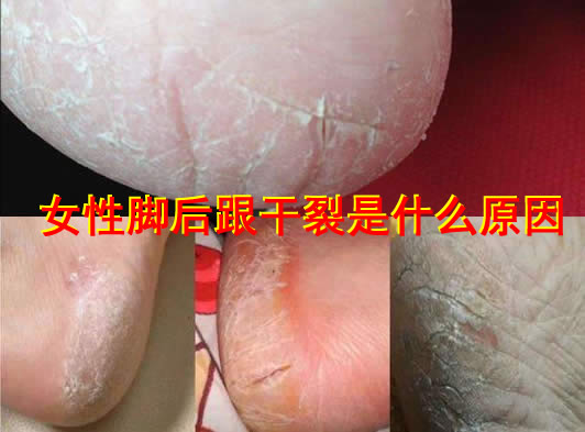 女性脚后跟干裂是什么原因？具体缓解方法解读