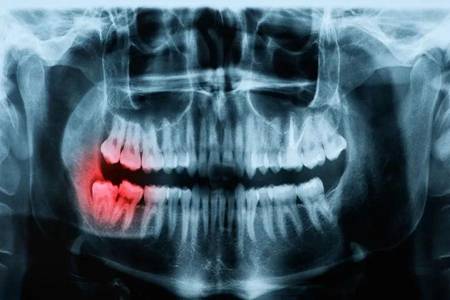 智齿一定要拔吗?智齿出现发炎肿痛时再不拔就晚了