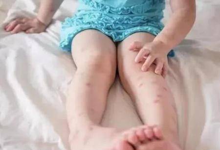 小宝宝夏天被蚊虫叮咬怎么办？七个预防蚊虫叮咬的方法