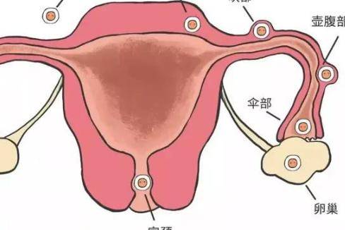 孕前认识宫外孕是什么 详讲造成宫外孕的三种原因