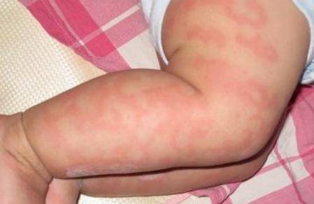 春天户外玩幼儿皮肤过敏怎么办？家长一定要懂得这些正确做法