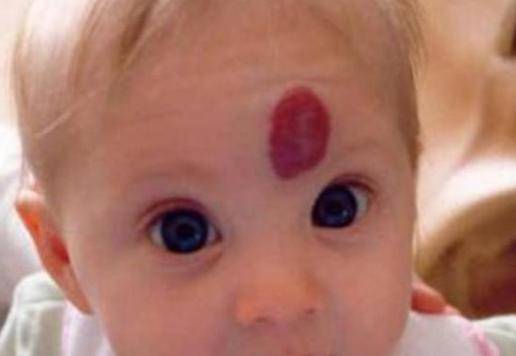 胎记是怎么形成的?怀孕期间三个行为可能会让宝宝有胎记