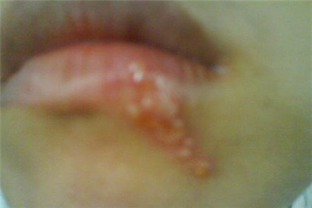 经常嘴唇上长水泡或是这三个原因