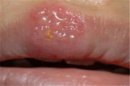 经常嘴唇上长水泡或是这三个原因