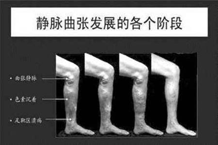 静脉曲张的危害有哪些 静脉曲张的治疗方法有哪几种