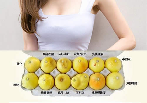 乳腺癌早期症状解读