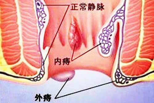 真实女性痔疮图片：女性痔疮的症状及危害