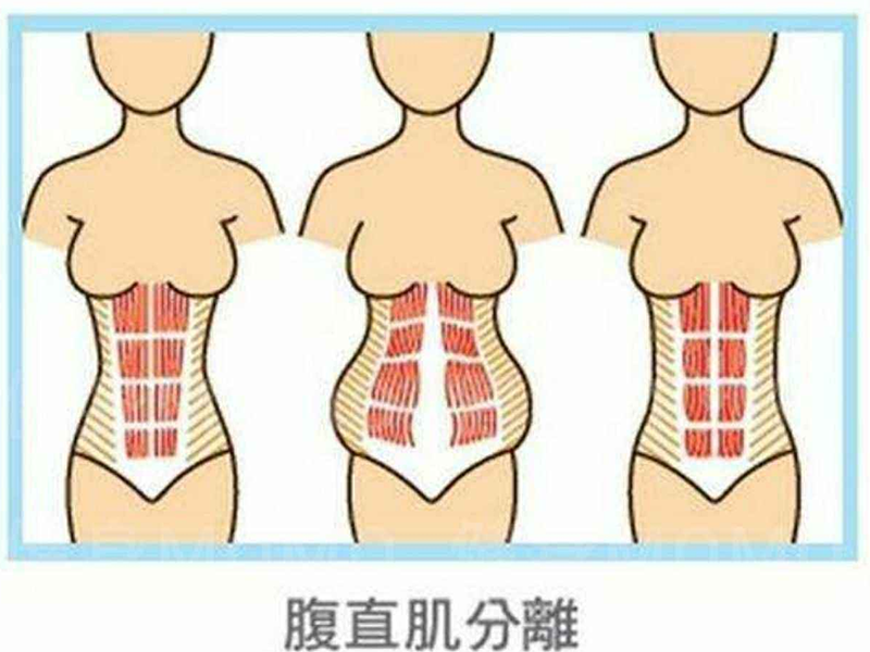 生完孩子后,肚子像瘪下去的＂气球＂还能恢复吗？