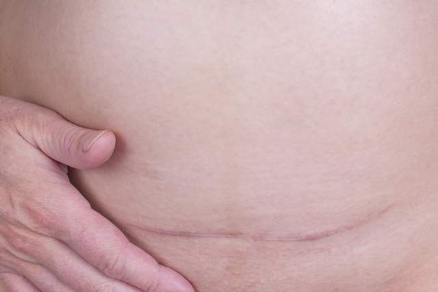 顺产对身体伤害小,产后恢复快,但剖腹产的三个好处,它比不了