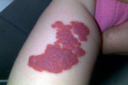 血管瘤是怎么形成的？怎么预防血管瘤复发