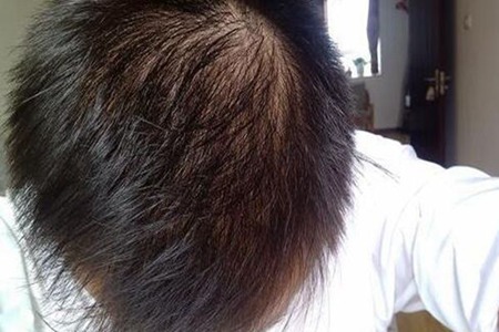 肾虚型脱发怎么改善？肾虚型脱发的原因