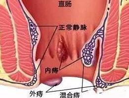怎么判断自己得了痔疮？痔疮出血怎么治疗方法简单
