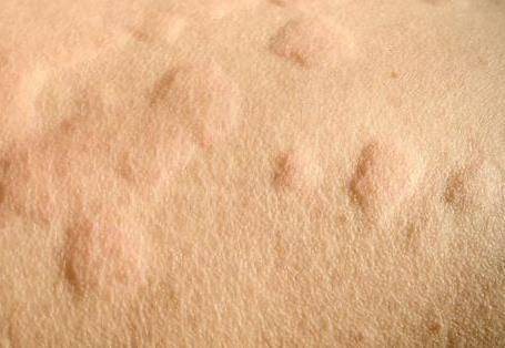 荨麻疹是什么原因引起的 应该怎么样治疗？