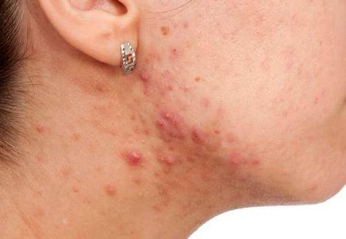 女人肝脏不好有什么表现症状 如何调养？