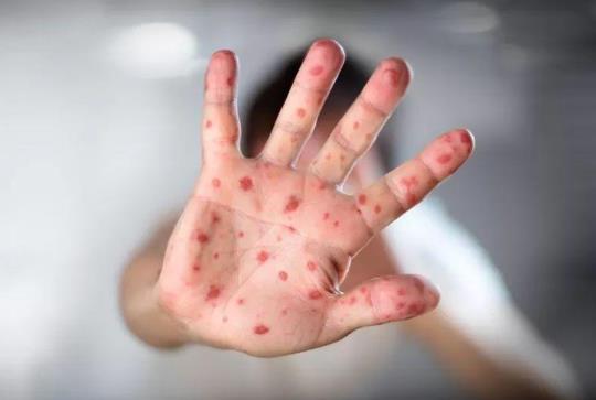 手足口病怕高温吗?手足口病不吃药能治愈吗