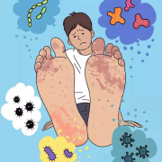 脚气怎么治能除根?
