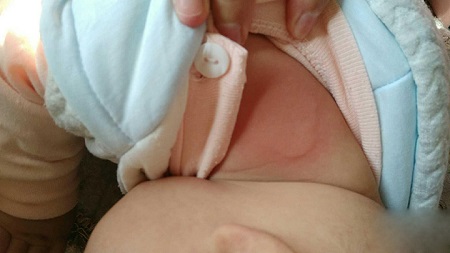 婴儿湿疹有三个主要诱因,作为父母,如何预防和护理婴儿湿疹？