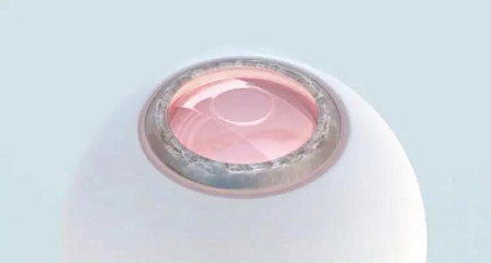 PRL晶体植入手术开启美好视界助力眼健康事业