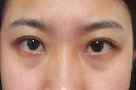 黑眼圈重怎么快速消除？这四个去黑圈最有效的方法